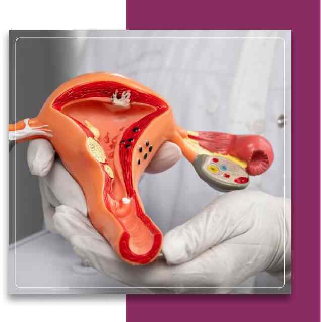 Types of Cervical Cancer Types of Cervical Cancer