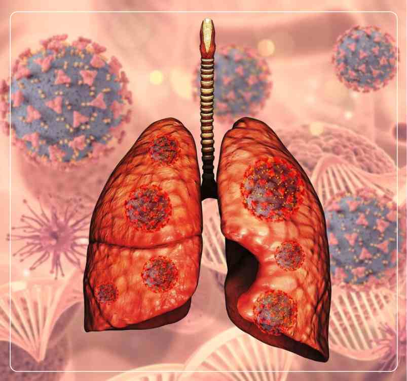 Types of Lung Cancer