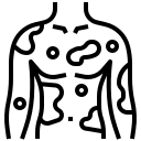 Neurofibromatosis type 2