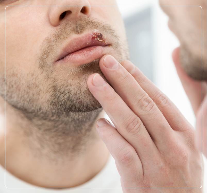 Lip Cancer Symptoms
