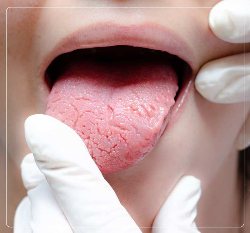 Tongue Cancer Doctor in Kolkata