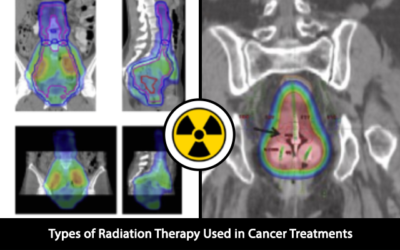 Types of Radiation Therapy Used in Cancer Treatments